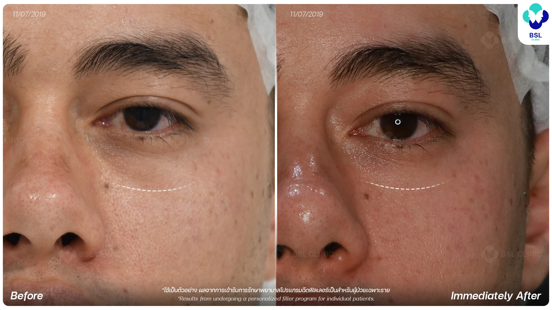 HA Filler Program Under Eye Filler Program for Tired Looking Eyes