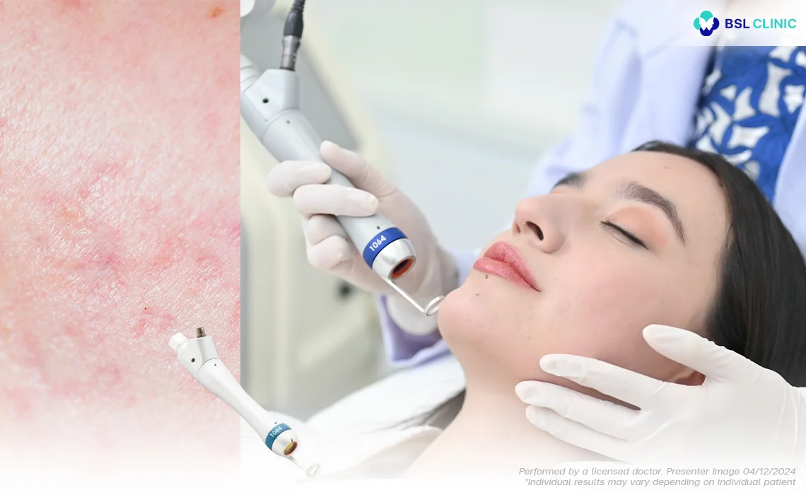 pico laser bangkok price picoway laser treatment for acne scars enlarged pores and uneven skin texture bangkok pico laser before and after bsl clinic