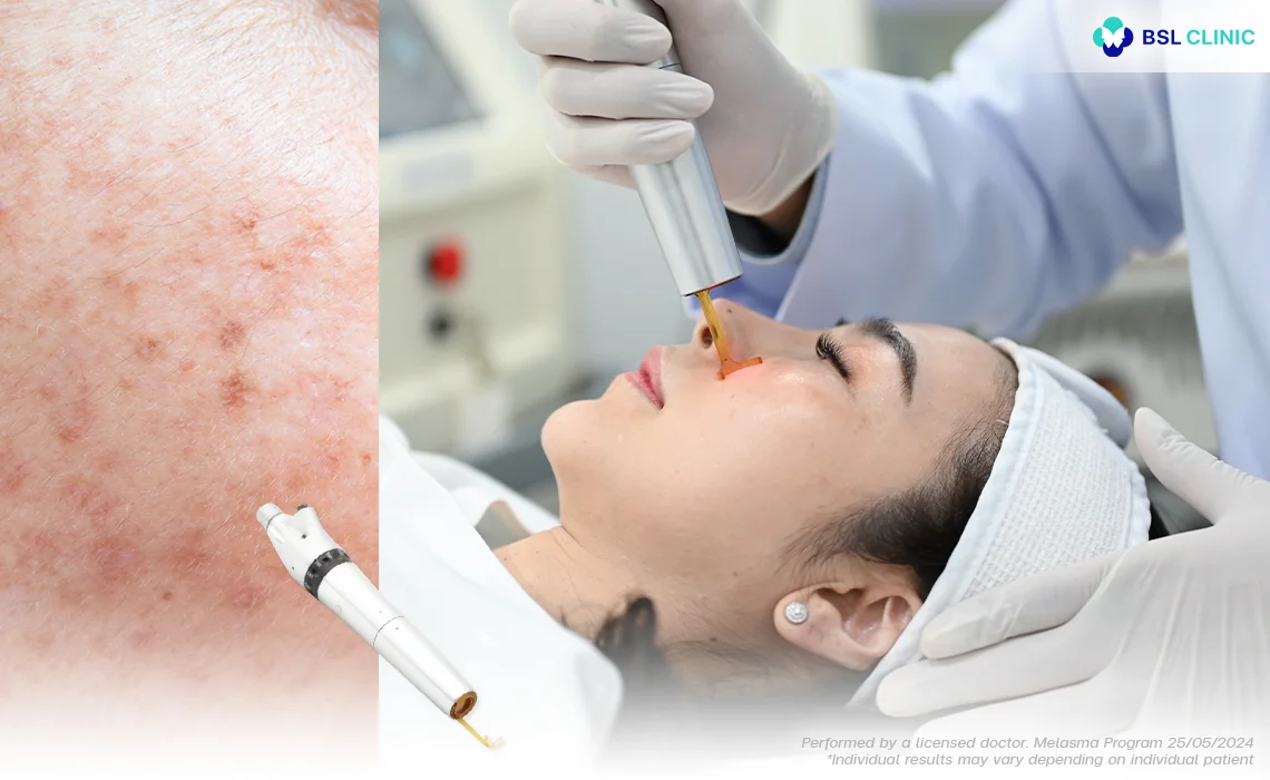 picoway laser treatment for freckles dark spots and pigmentation bangkok thailand pico laser for uneven skin tone bsl clinic