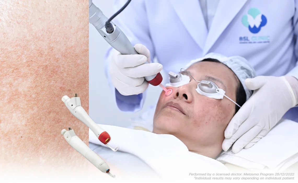 pico laser thailand picoway laser treatment for melasma dark spots and pigmentation bangkok thailand pico laser treatment at bsl clinic