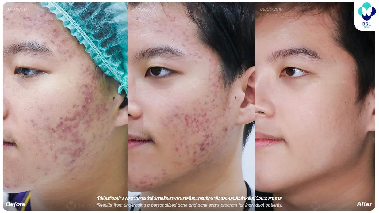 โปรแกรมเลเซอร์สิวและหลุมสิว