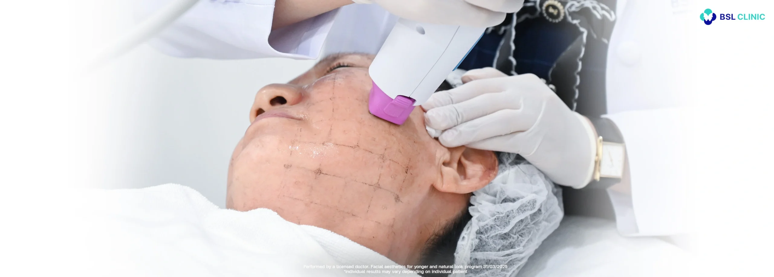 thermage flx rf treatment bangkok non invasive skin tightening on face using monopolar radiofrequency technology by solta performed at bsl clinic without needles or surgery