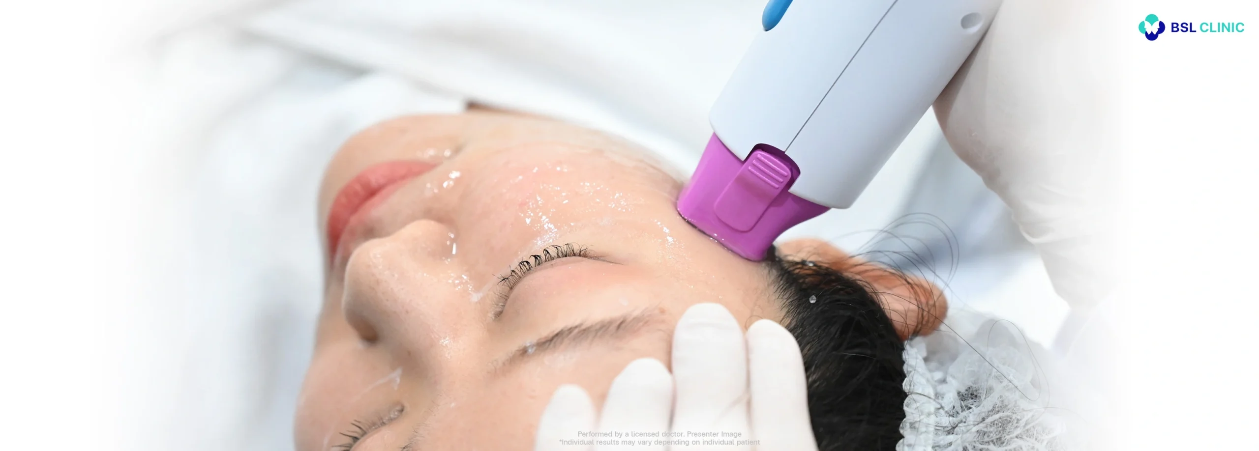 thermage flx rf treatment bangkok face skin tightening using monopolar radiofrequency by solta at bsl clinic for firmer smoother looking skin without injections or surgery