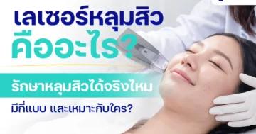 เลเซอร์หลุมสิว รักษาหลุมสิว