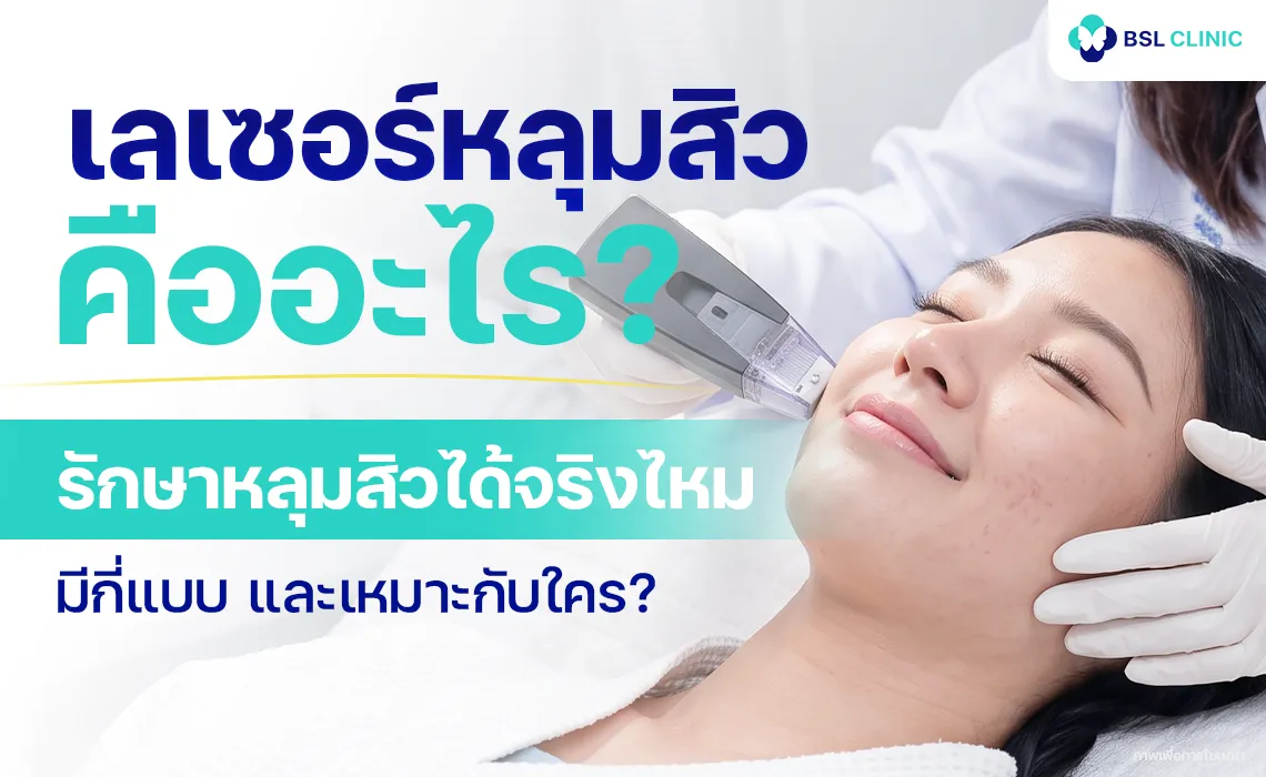 เลเซอร์หลุมสิว รักษาหลุมสิว