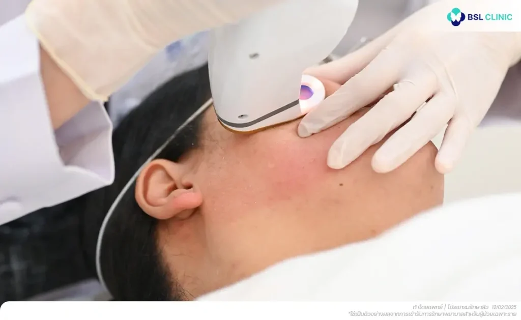 Accure Laser Program