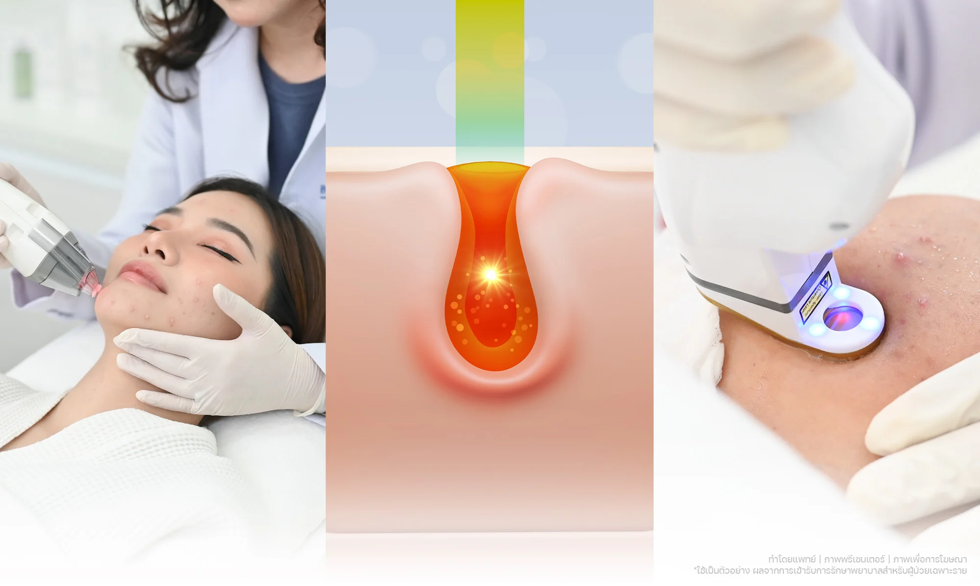 รักษาสิว-สิวอุดตัน-สิวอักเสบ-สิวหัวหนอง BSL Clinic