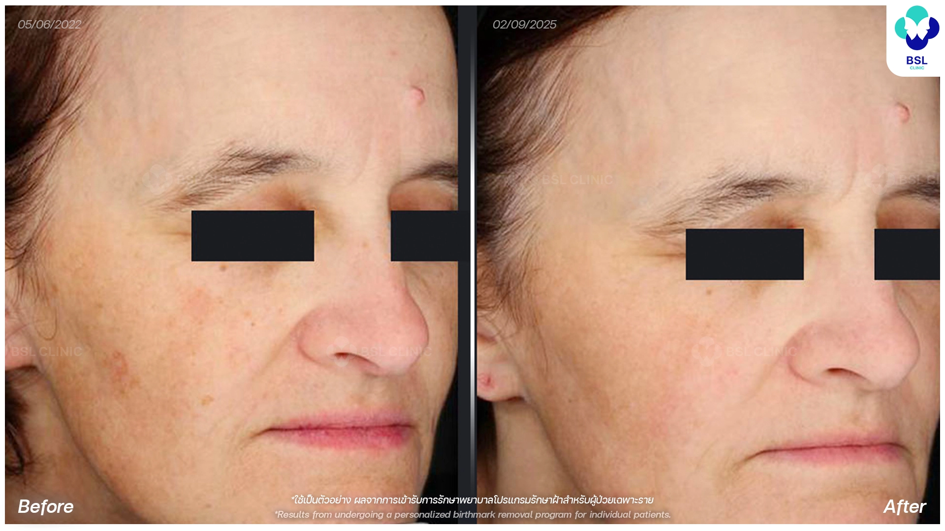 picoway laser before and after freckles dark spots treatment bangkok thailand pico laser for pigmentation bsl clinic
