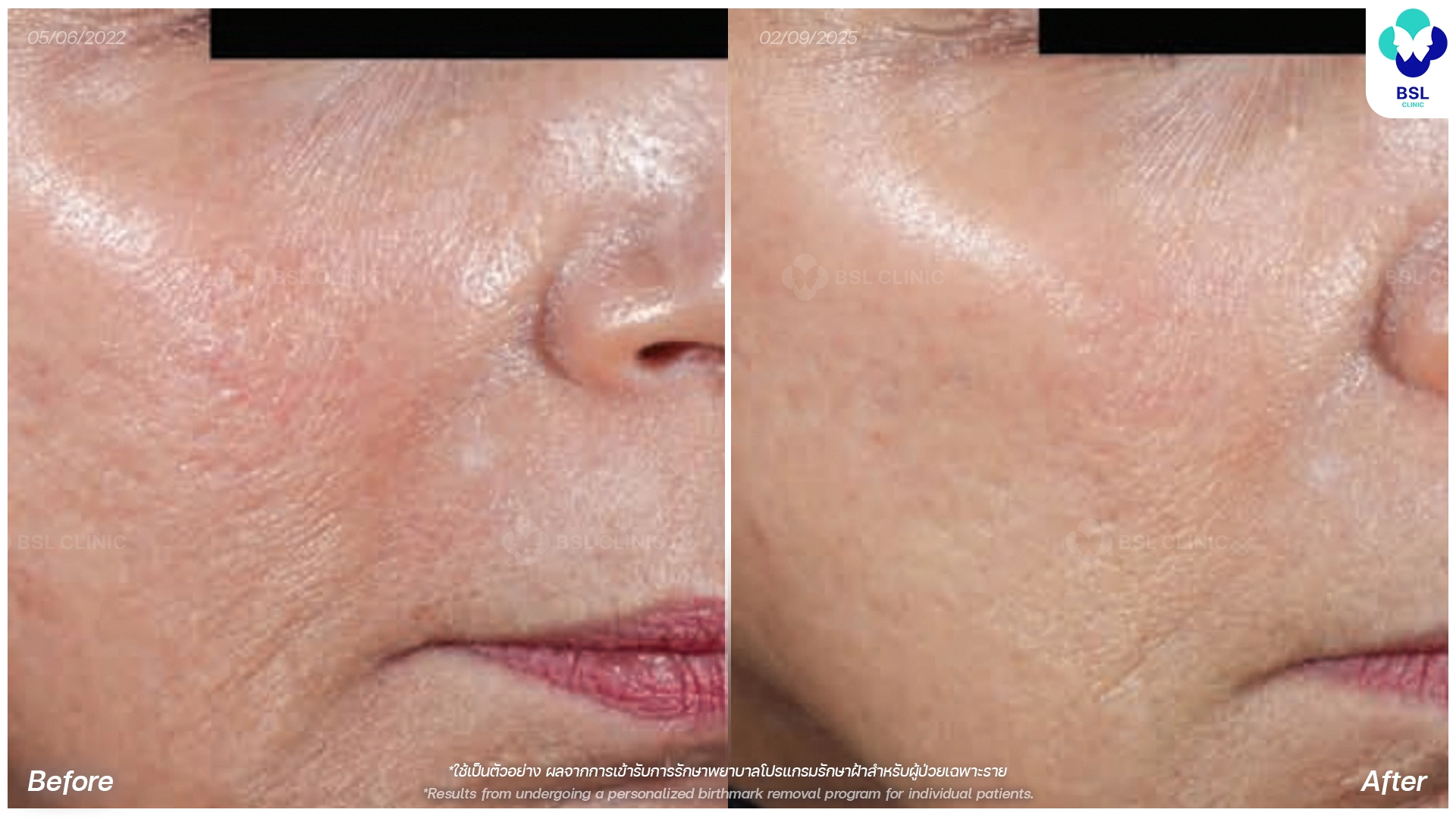 picoway laser before and after acne scars treatment bangkok thailand pico laser for acne scars bsl clinic