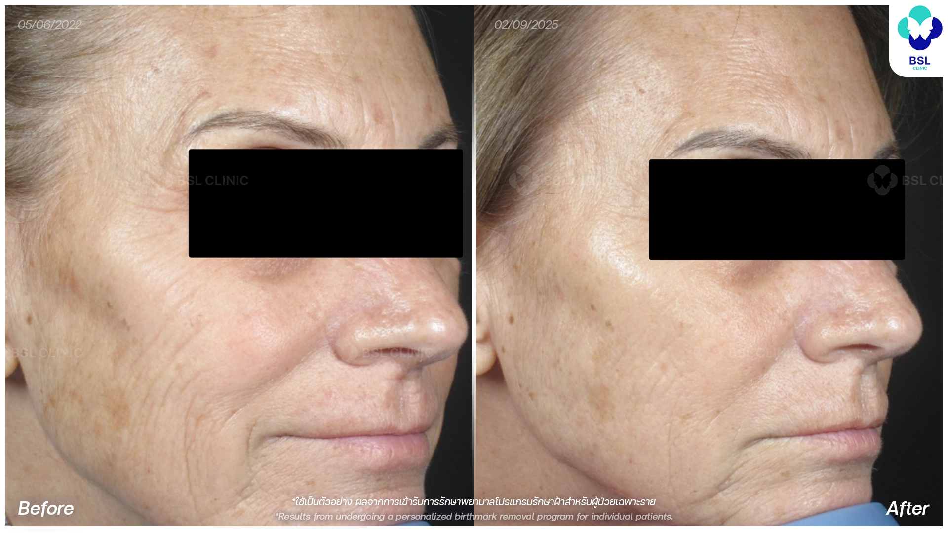 picoway laser before and after wrinkles treatment bangkok thailand pico laser rejuvenation bsl clinic