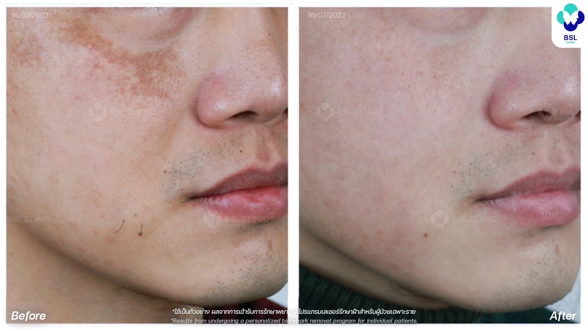 picoway laser before and after melasma treatment bangkok thailand pico laser for pigmentation bsl clinic