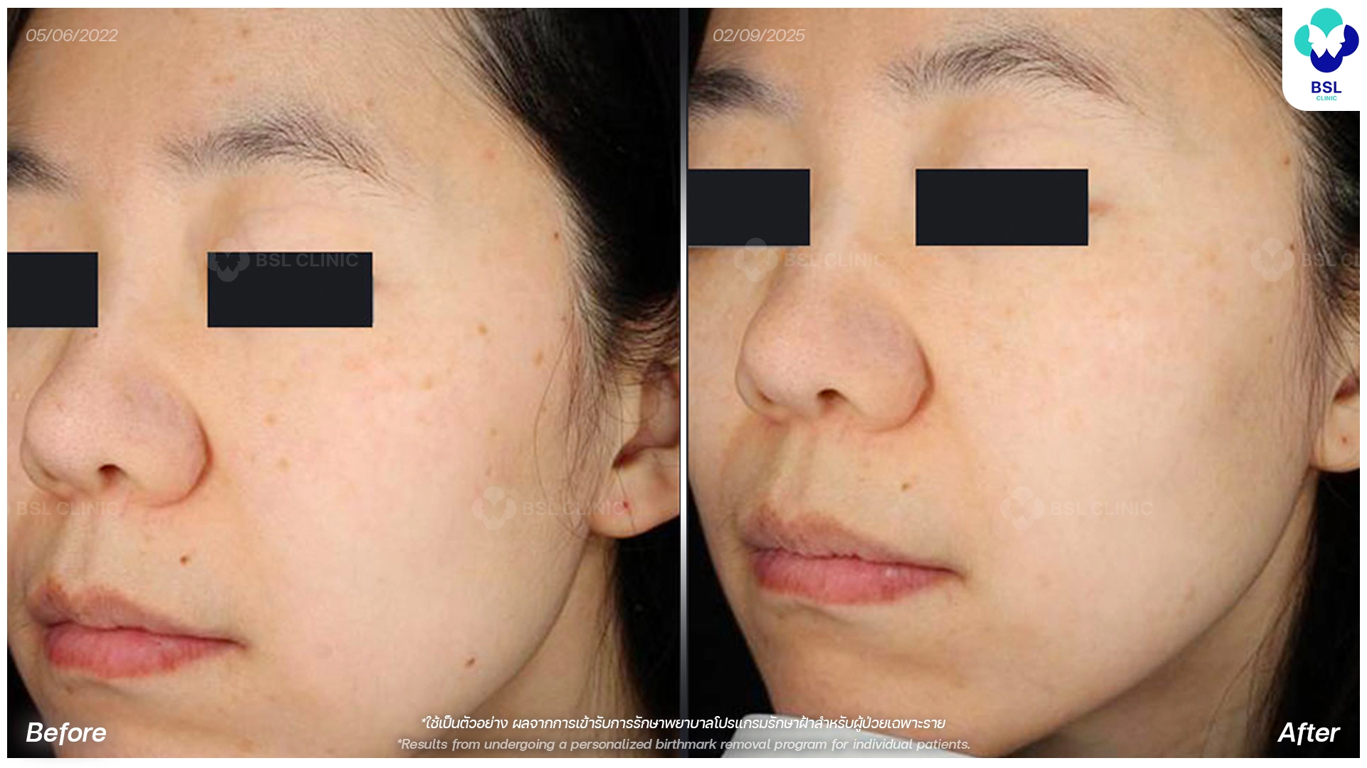 picoway laser before and after freckles dark spots treatment bangkok thailand pico laser for pigmentation bsl clinic