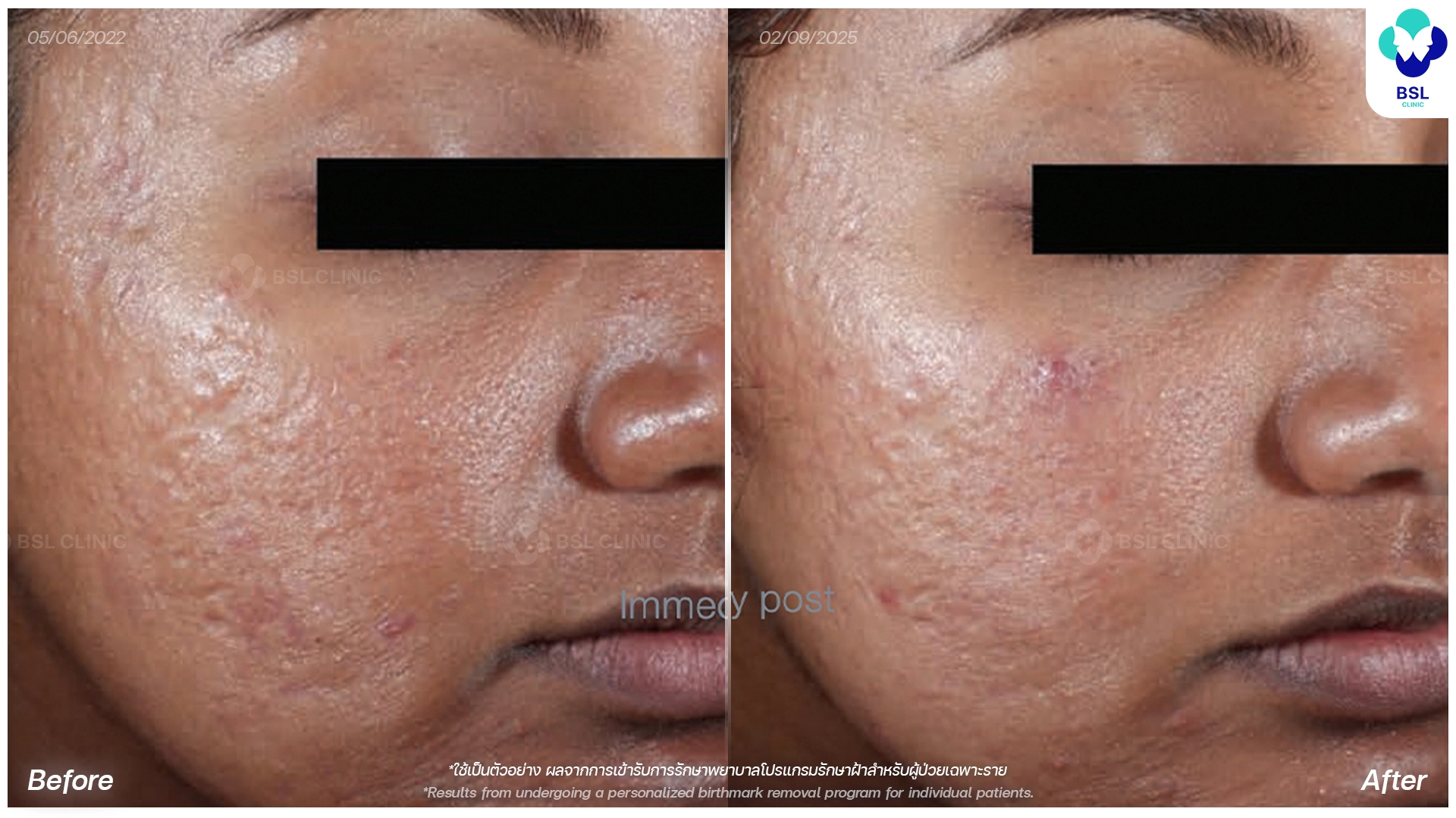 picoway laser before and after acne scars treatment bangkok thailand pico laser for acne scars bsl clinic