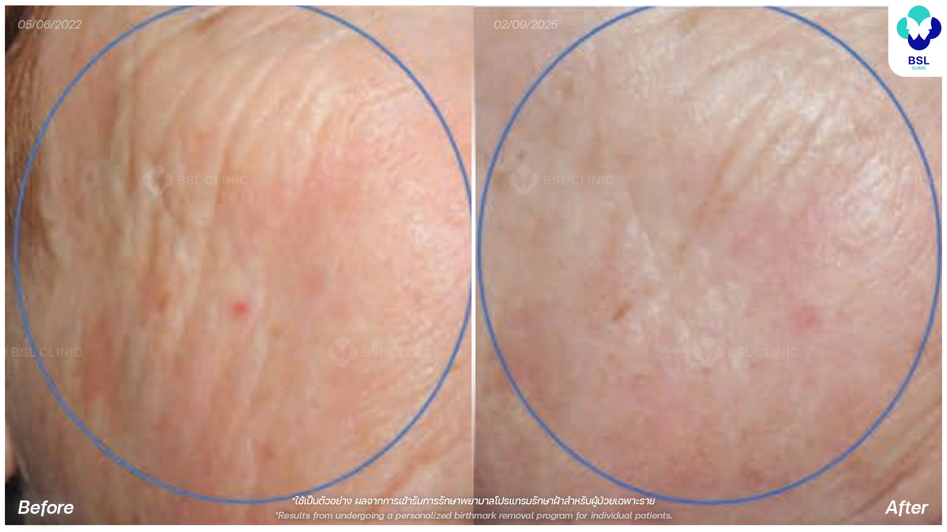 picoway laser before and after wrinkles treatment bangkok thailand pico laser rejuvenation bsl clinic
