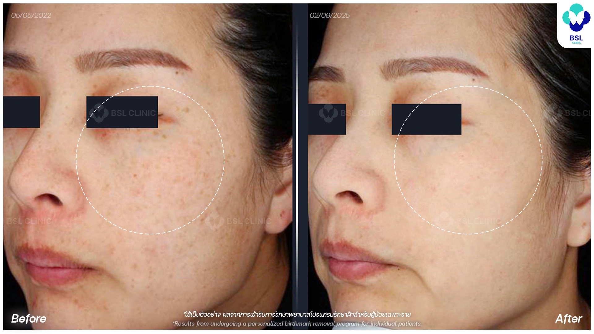 pico laser in bangkok before and after pigmentation and dark spots treatment thailand bsl clinic