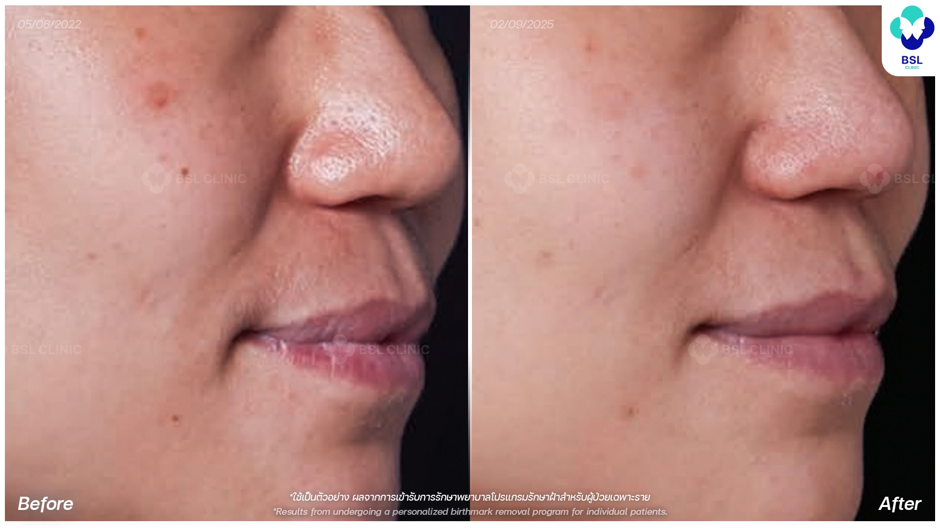 picoway laser before and after freckles dark spots treatment bangkok thailand pico laser for pigmentation bsl clinic