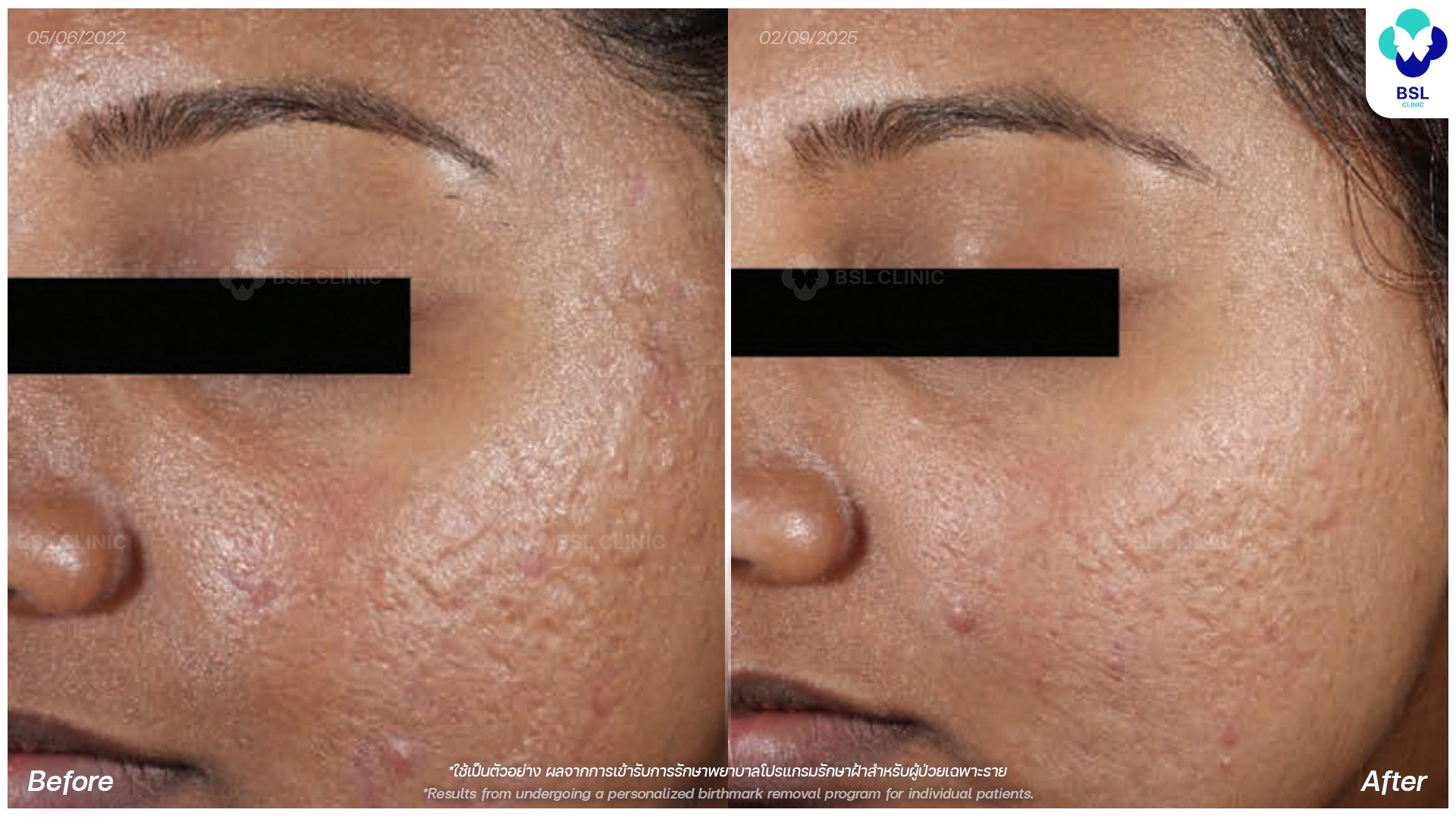 picoway laser before and after acne scars treatment bangkok thailand pico laser for acne scars bsl clinic