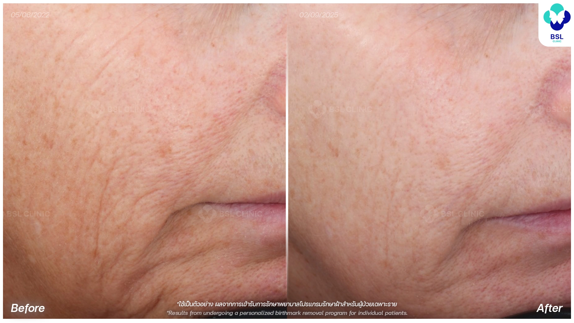 picoway laser before and after wrinkles treatment bangkok thailand pico laser rejuvenation bsl clinic