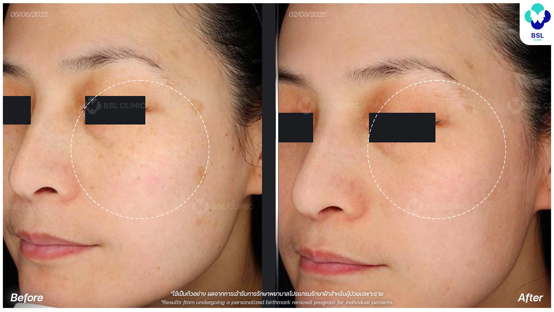 picoway laser melasma before and after bangkok thailand pico laser treatment for sun damage