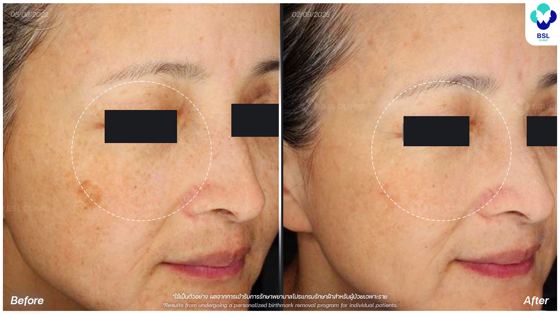 pico laser for pigmentation and melasma before and after results bangkok bsl clinic