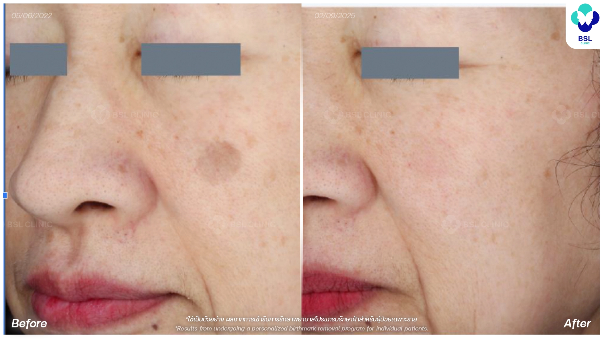 picoway laser treatment thailand before and after melasma dark patches pico laser in bangkok