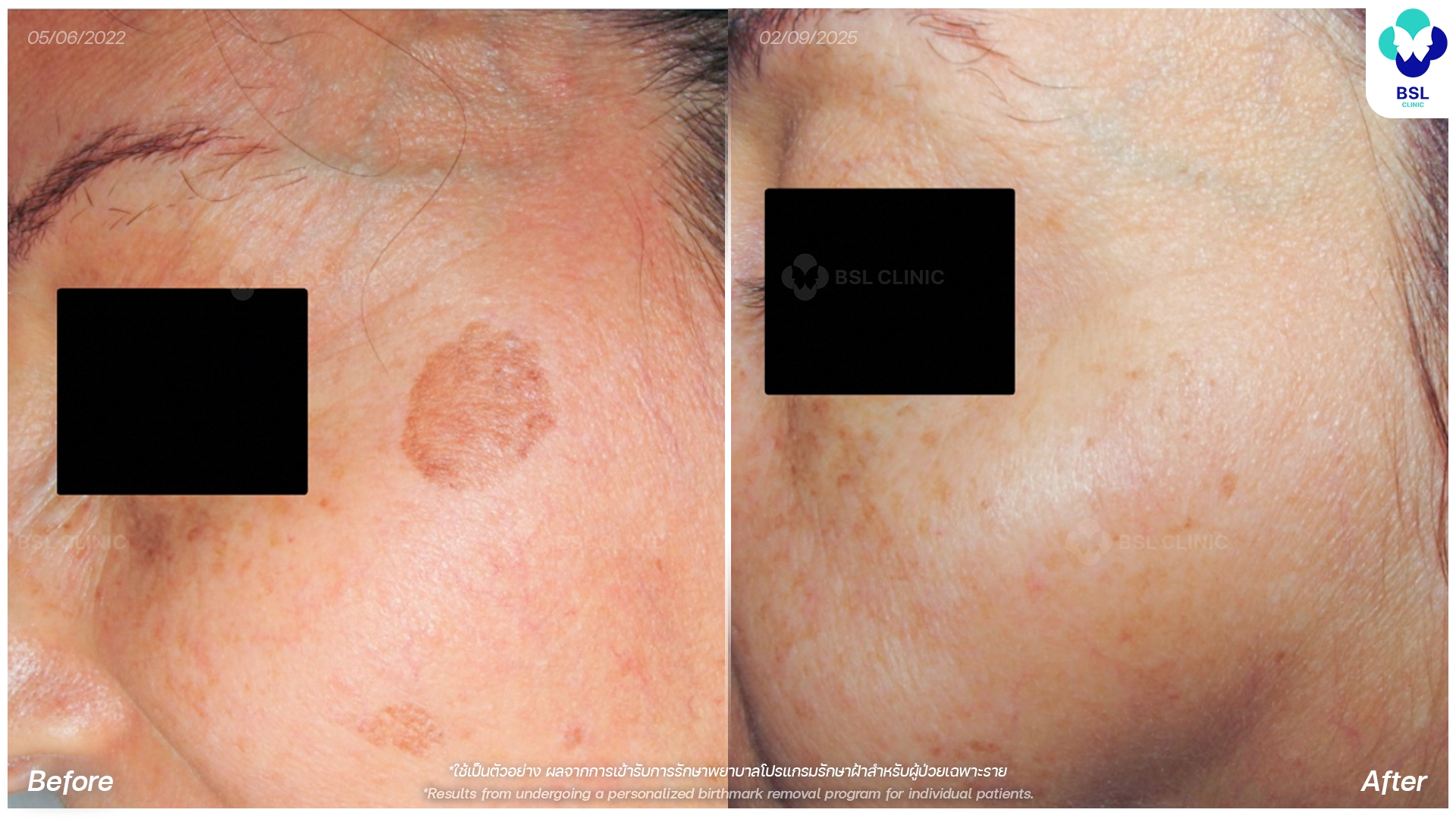 pico laser before and after bangkok thailand picoway treatment for hyperpigmentation bsl clinic