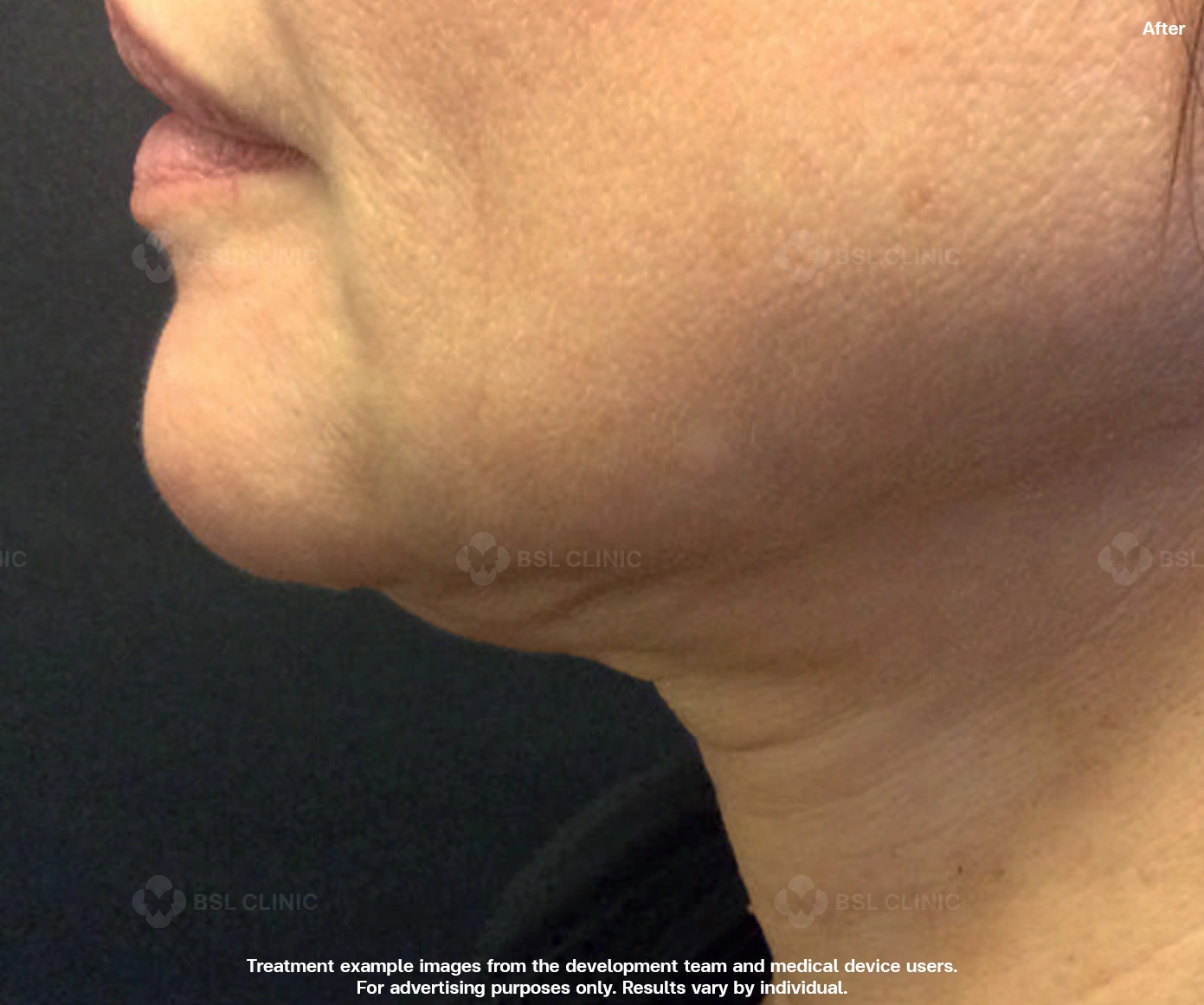 thermage skin tightening double chin neck laxity submental area before after results