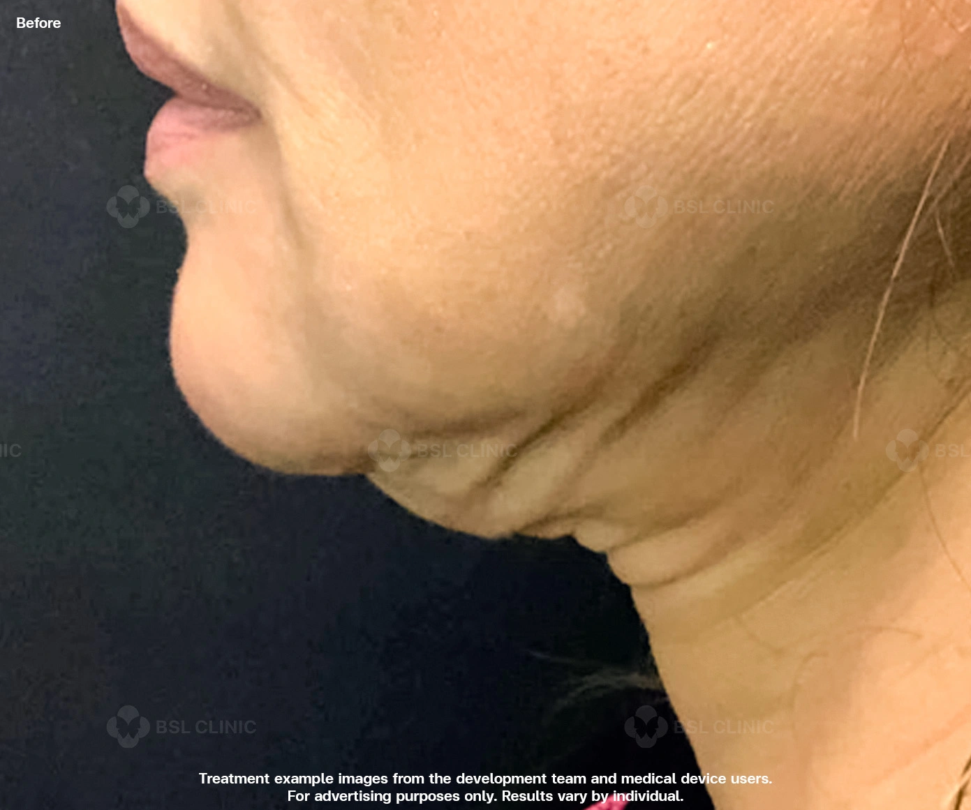 thermage-skin-tightening-double-chin-neck-laxity-submental-area-before-results- thermage-skin-tightening-double-chin-neck-laxity-submental-area-before-results-