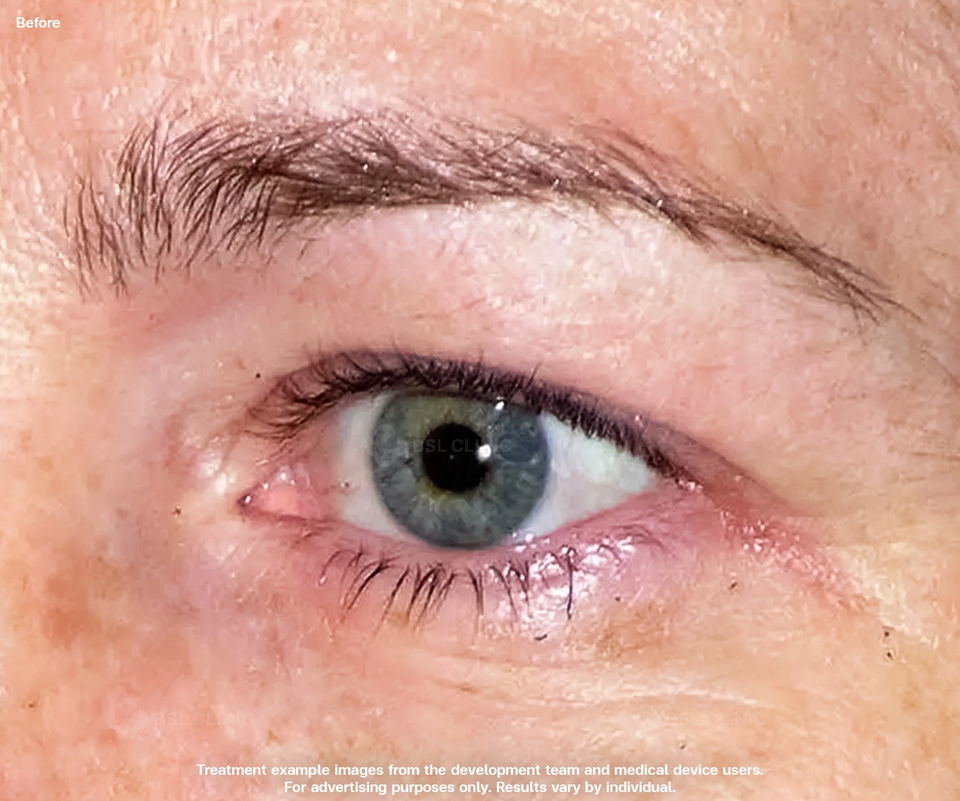 thermage-skin-tightening-eye-area-before-under-eye-wrinkles-laxity-treatment-edit01 thermage-skin-tightening-eye-area-before-under-eye-wrinkles-laxity-treatment-edit01