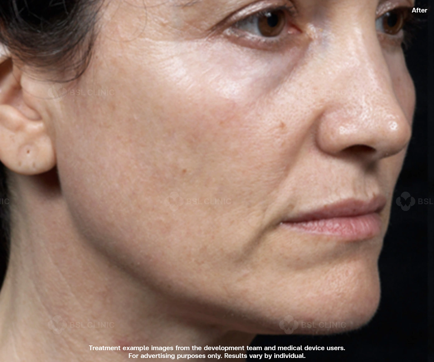 thermage skin tightening full face cheeks before after fine lines nasolabial folds