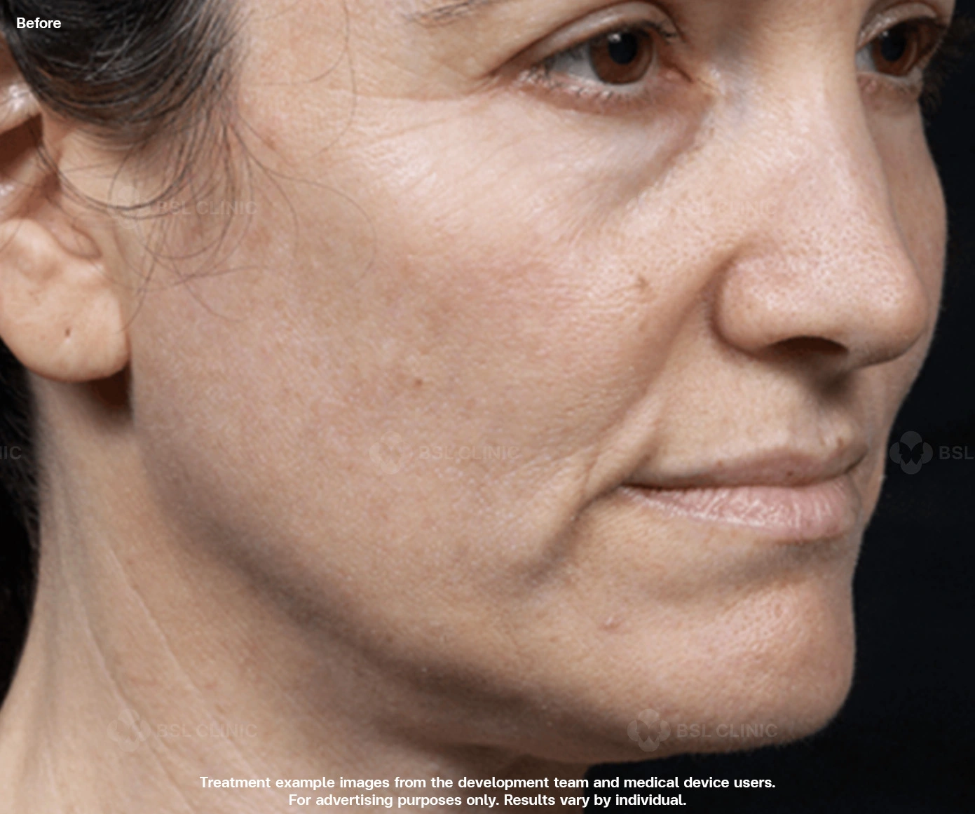 thermage-skin-tightening-full-face-cheeks-before-fine-lines-nasolabial-folds thermage skin tightening full face cheeks before after fine lines nasolabial folds