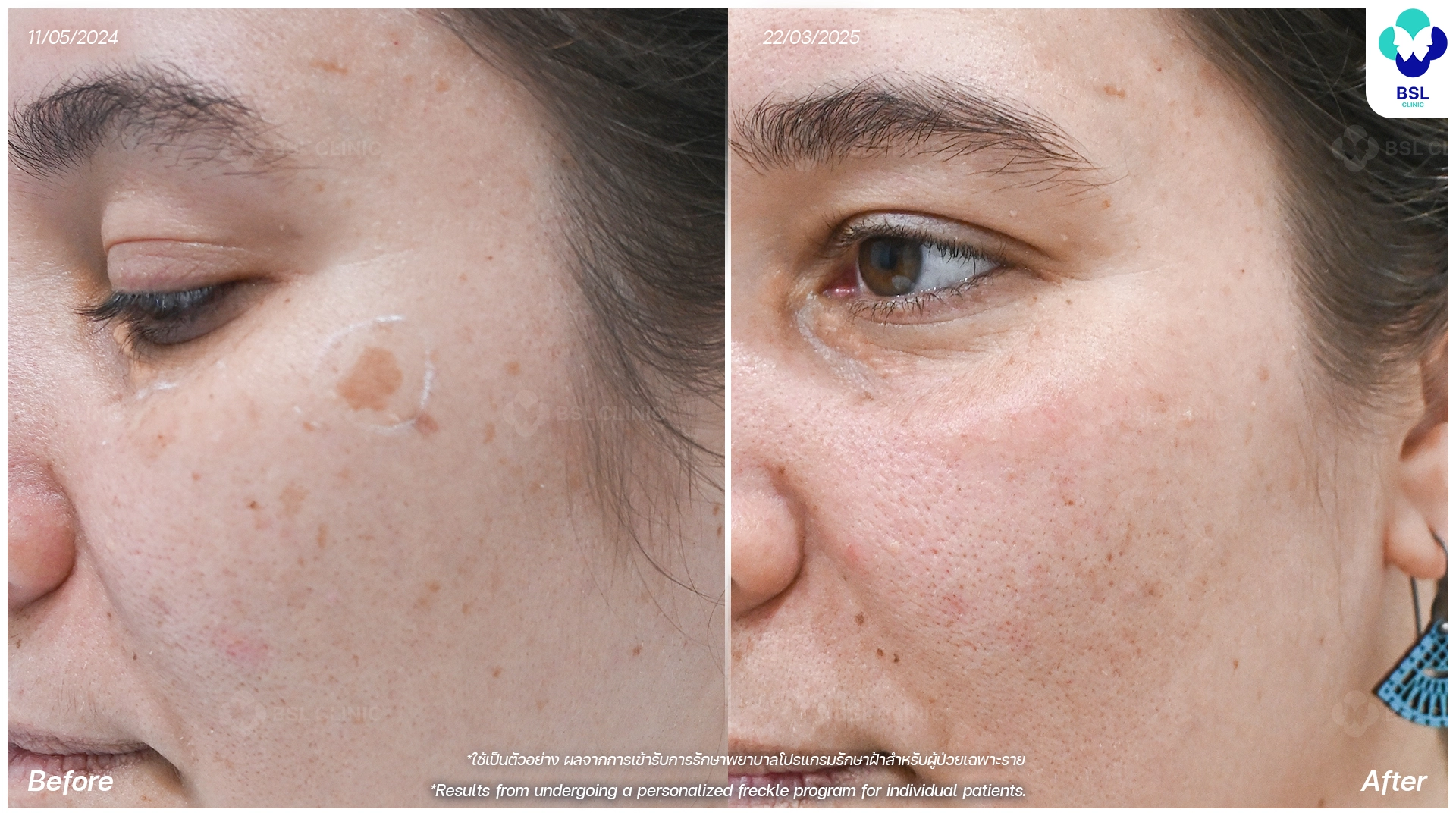 picoway laser before and after for pigmentation dark spots and uneven skin tone pico laser treatment bangkok thailand bsl clinic