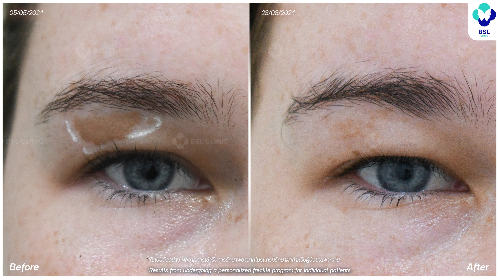 picoway laser before and after for pigmentation dark spots and uneven skin tone pico laser treatment bangkok thailand bsl clinic