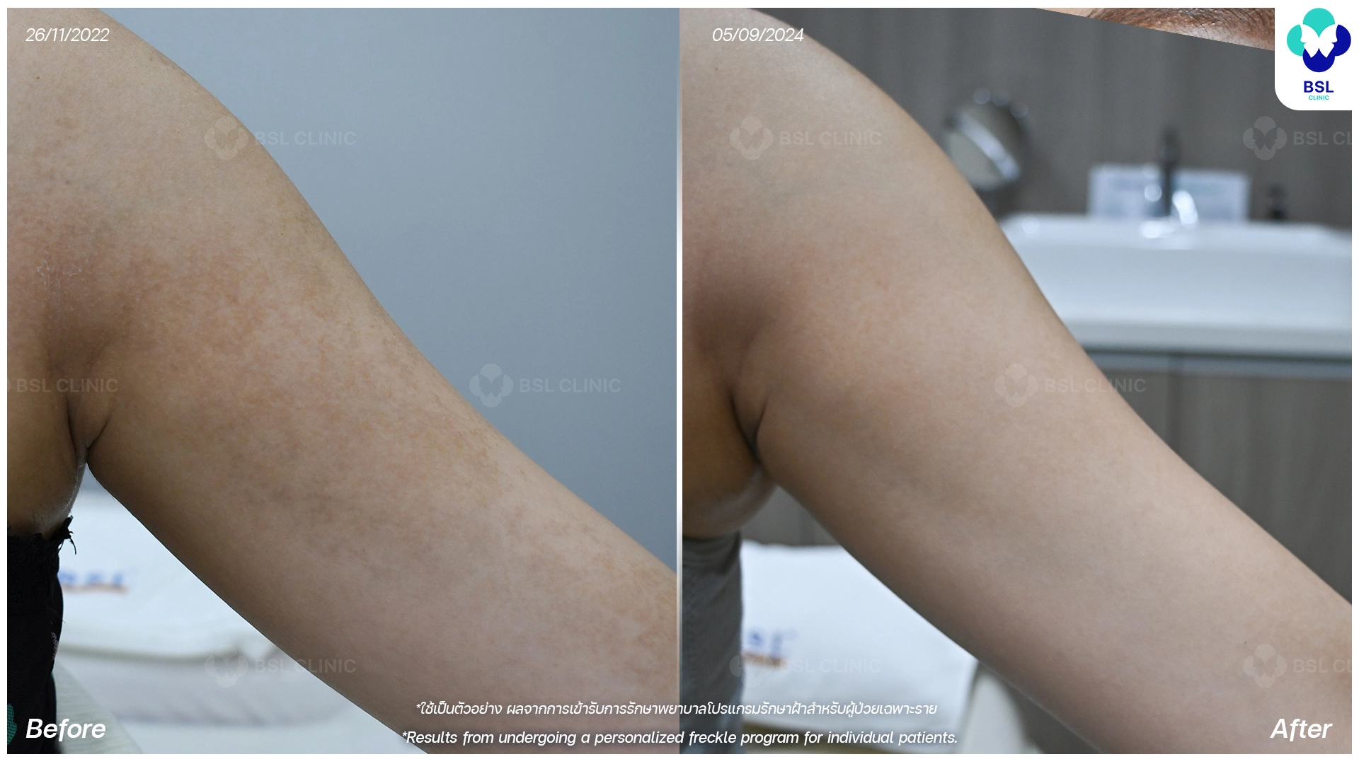 picoway laser before and after for pigmentation dark spots and uneven skin tone pico laser treatment bangkok thailand bsl clinic