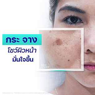 กระจางลง-ที่บีเอสแอล-รีวิวรักษากระ