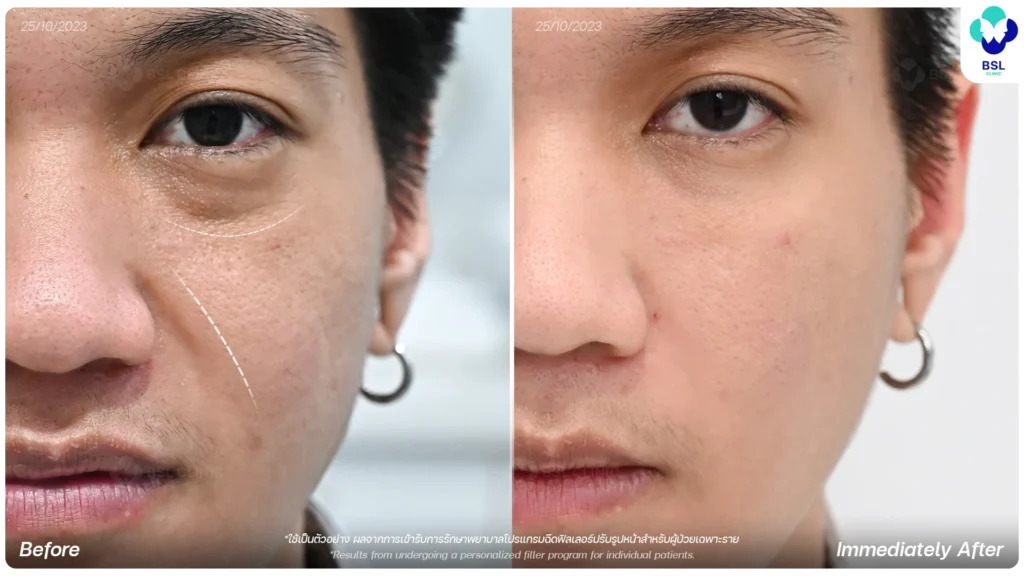 ผลการรักษา ปรับรูปหน้า โปรแกรมฉีดฟิลเลอร์ BSL Clinic