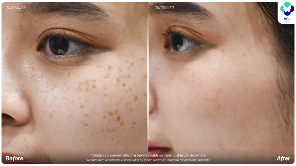 คลินิกผิวหนัง รักษาสิว ฝ้า กระ แผลเป็น โดยแพทย์ | BSL Clinic