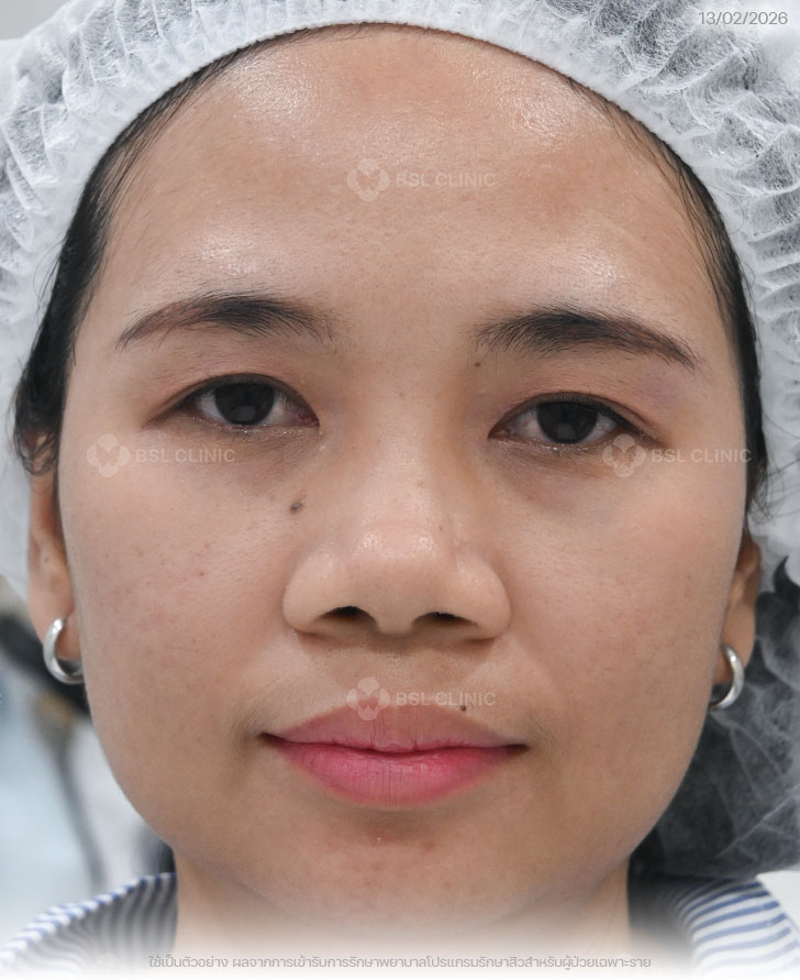 ผลการรักษาสิว-สิวอุดตัน-รอยดำสิว-After