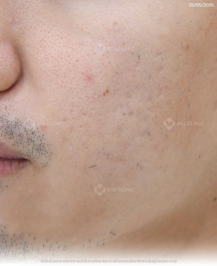 ผลการรักษาสิว-สิวอุดตัน-สิวอักเสบ-รอยแดงสิว-After