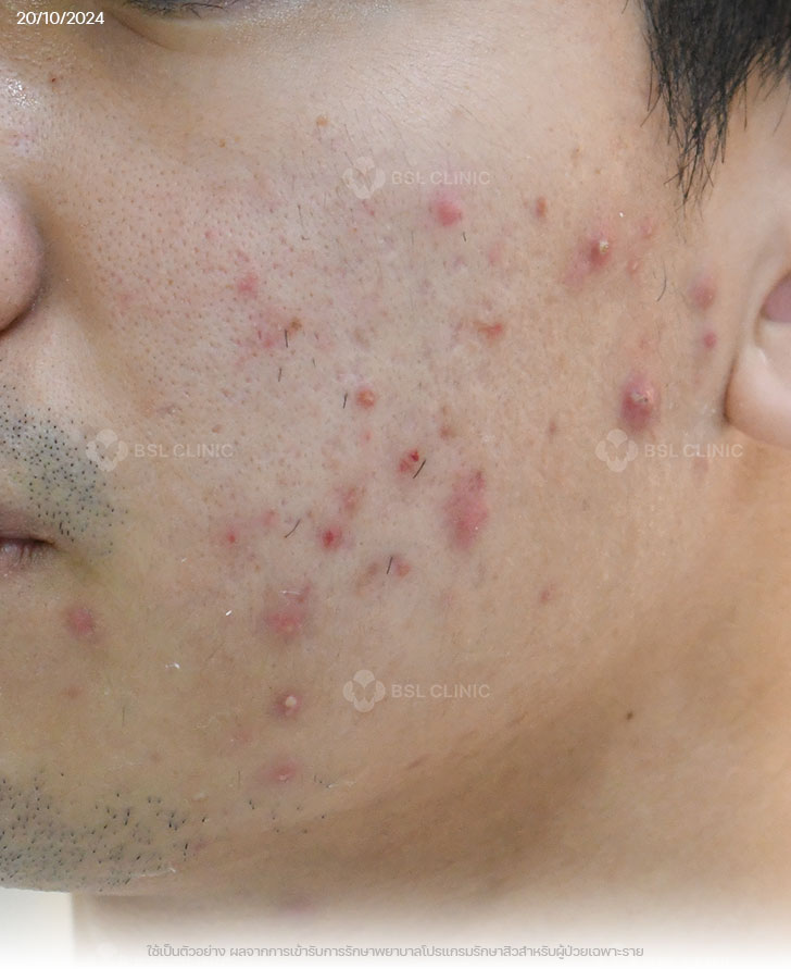 ผลการรักษาสิว-สิวอุดตัน-สิวอักเสบ-รอยแดงสิว-Before