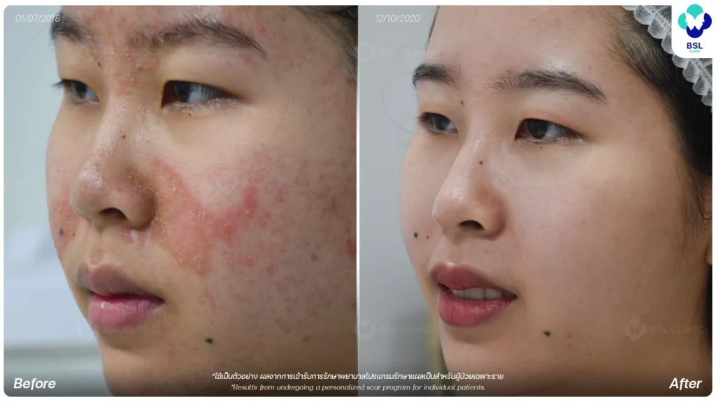 ผลการรักษาผิวแพ้ง่าย หน้าแดง BSL Clinic