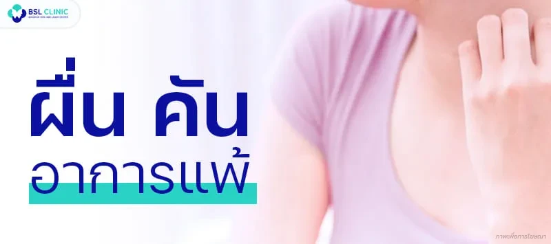 ผื่น คัน อาการแพ้