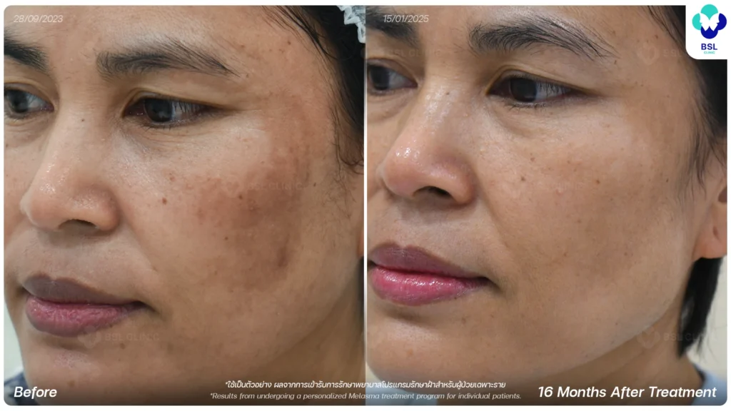 ผลการรักษาฝ้า กระ จุดด่างดำ ผิวหมองคล้ำ ที่ BSL Clinic