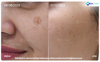 ฝ้า-ศูนย์เลเซอร์ผิวหนัง-กระตื้น-กระลึก-BA-1