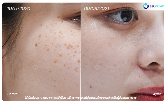 ฝ้า-ศูนย์เลเซอร์ผิวหนัง-กระตื้น-กระลึก-BA-2