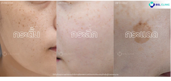 ฝ้า-ศูนย์เลเซอร์ผิวหนัง-กระตื้น-กระลึก