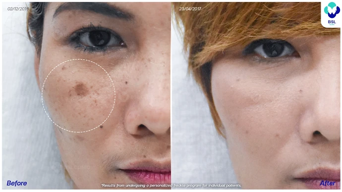 ฝ้า-ศูนย์เลเซอร์ผิวหนัง-ภาพปัญหากระ-BA-คุณณัฐกันต์