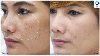ฝ้า-ศูนย์เลเซอร์ผิวหนัง-ภาพปัญหากระ-BA-คุณณัฐกันต์-2