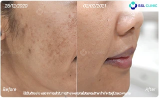 ฝ้า-ศูนย์เลเซอร์ผิวหนัง-รีวิวการรักษาฝ้า-BA