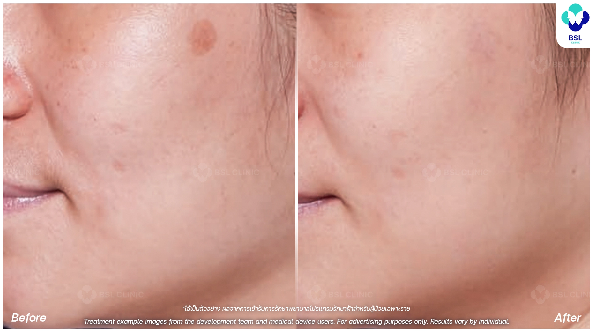 picoway laser before and after for pigmentation dark spots and uneven skin tone pico laser treatment bangkok thailand bsl clinic